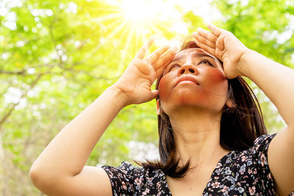 photo of a woman with a sunburned face standing in woods and looking skyward, sun is peeking through trees and she is holding her hands at the sides of her face